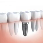 Dental Implants Done Dirt Cheap? Turkey Teeth Warning