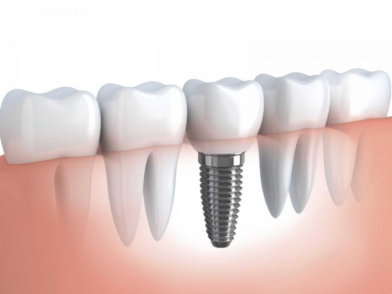 Dental Implants Done Dirt Cheap? Turkey Teeth Warning